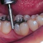 Ajuste Oclusal