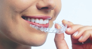 APARELHO INVISALIGN