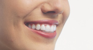 APARELHO INVISALIGN